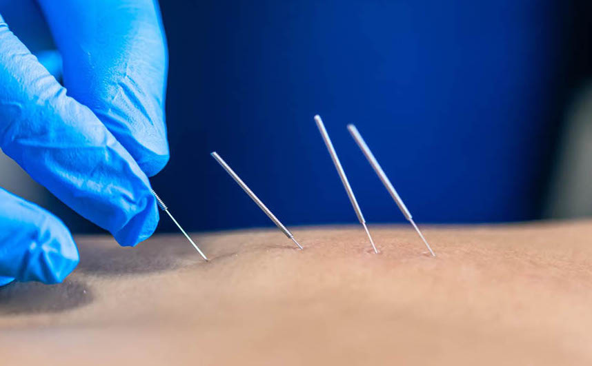Dry Needling in der Physiotherapie: Ausbildung, Sicherheit und bewährte Praktiken